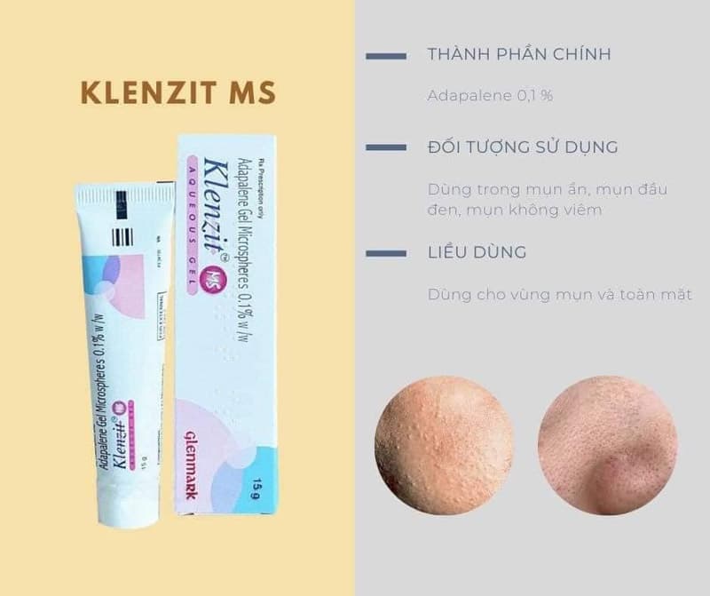CHẤM MỤN KLENZIT MS