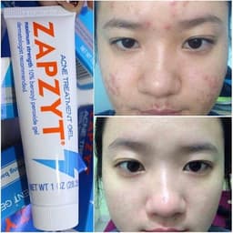 CHẤM MỤN ZAPZYT